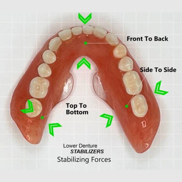 Showing the forces lower denture stabilizers exert on a lower denture.