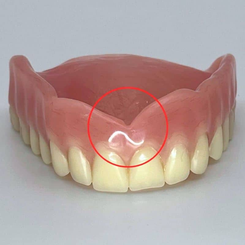 upper denture with v cut incorrectly