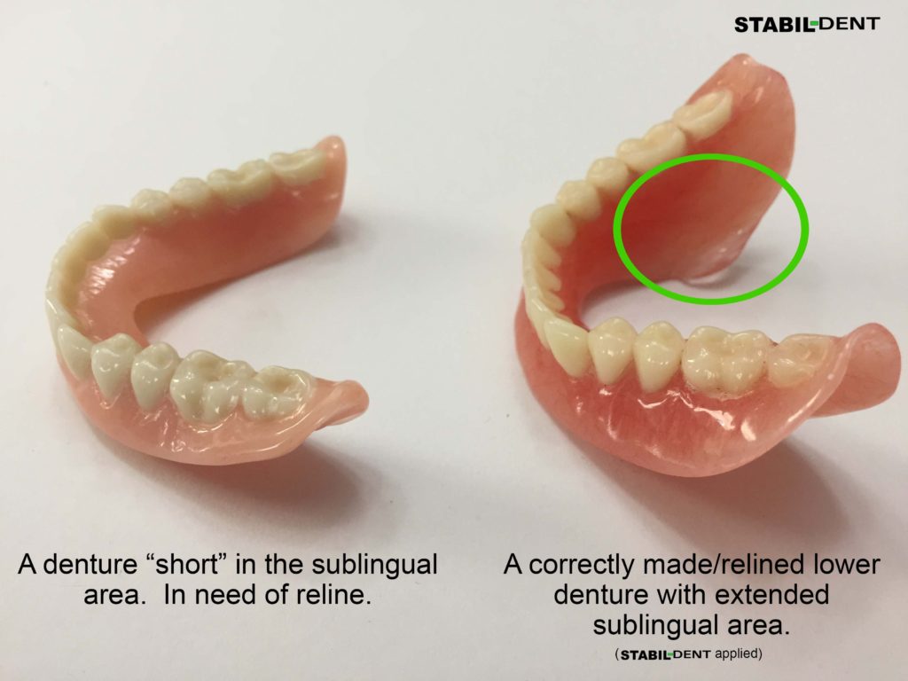 What You Need To Know To Get A Great Denture Reline   Correct Lower Denture Reline 1 1024x768 