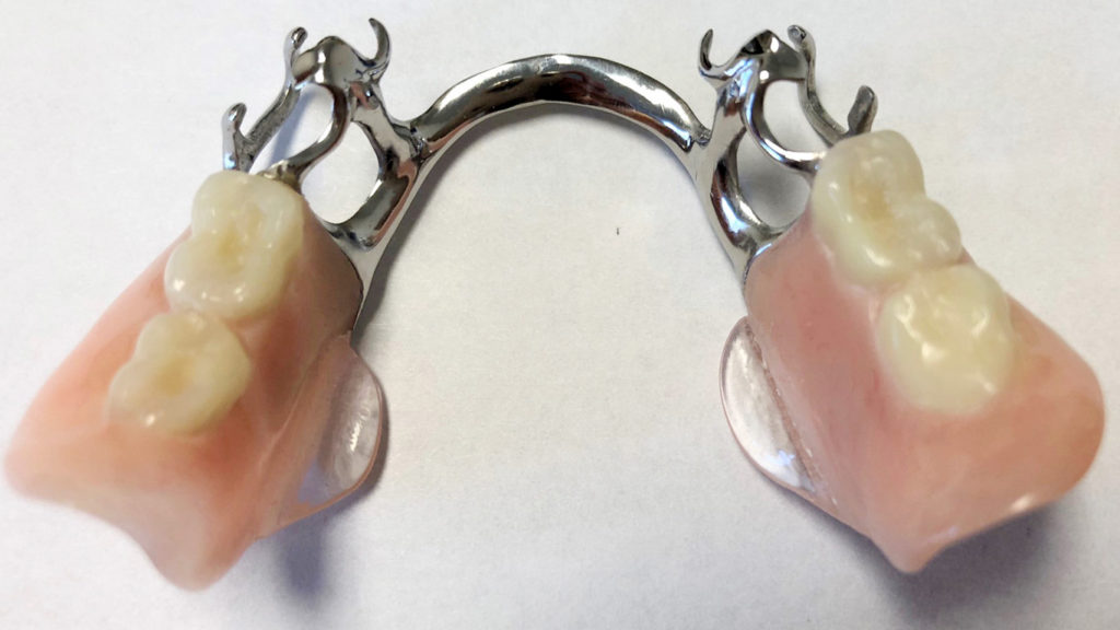 denture stabilizers on a partial denture
