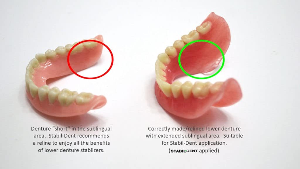 lower denture with proper sublingual area