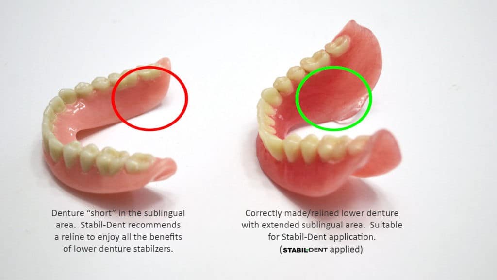 Denture Stabilization And Your Lower DentureStabildent