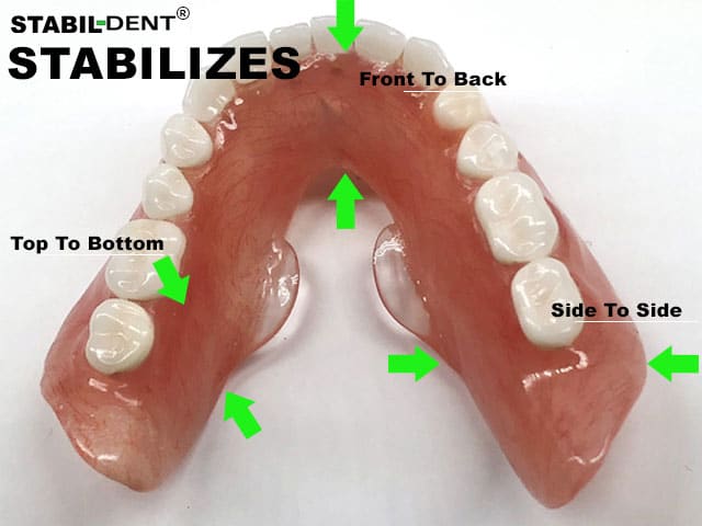 how stabildent lower denture stabilizers work